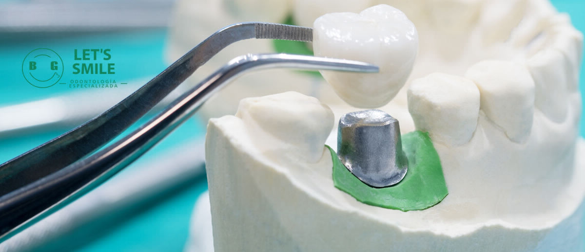 implantes dentales lets smile bg envigado