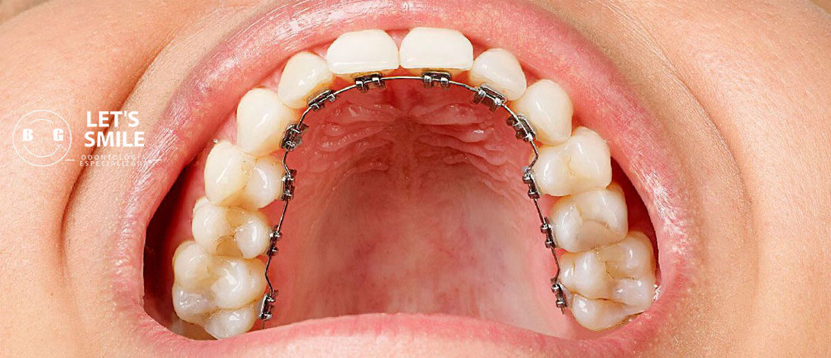 ortodoncia lingual lets smile bg